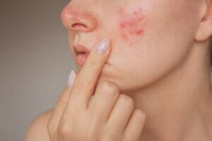 Close up image of either rosacea or acne