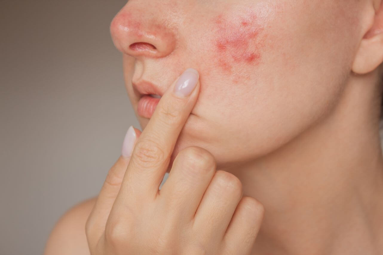 Close up image of either rosacea or acne