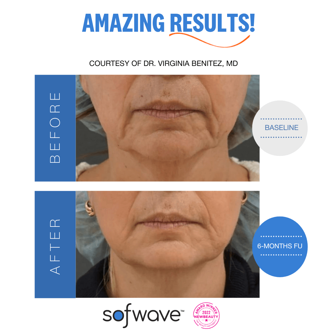 SofWave skin tightening uses ultrasound technology to stimulate collagen production, reducing wrinkles and enhancing skin texture.