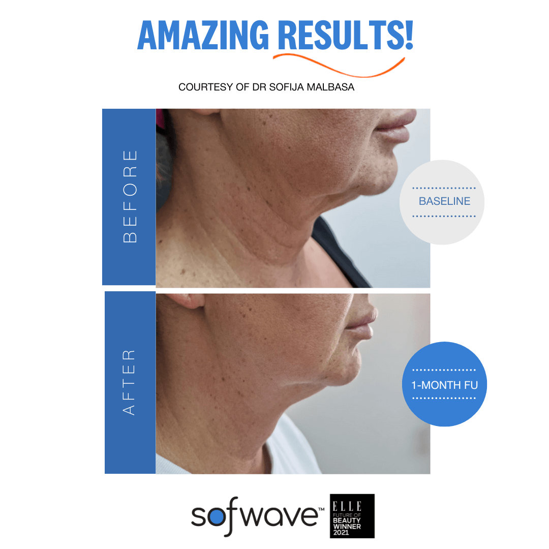 SofWave skin tightening uses ultrasound technology to stimulate collagen production, reducing wrinkles and enhancing skin texture.