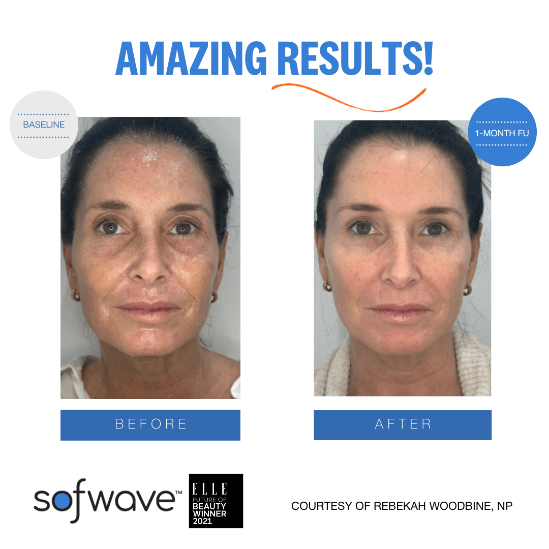 SofWave skin tightening uses ultrasound technology to stimulate collagen production, reducing wrinkles and enhancing skin texture.