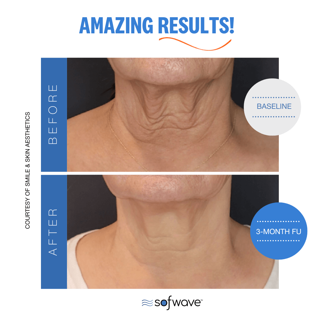 SofWave skin tightening uses ultrasound technology to stimulate collagen production, reducing wrinkles and enhancing skin texture.