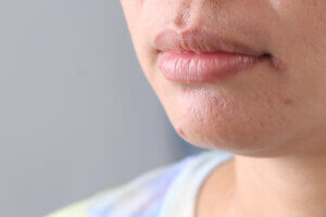 Angular Cheilitis