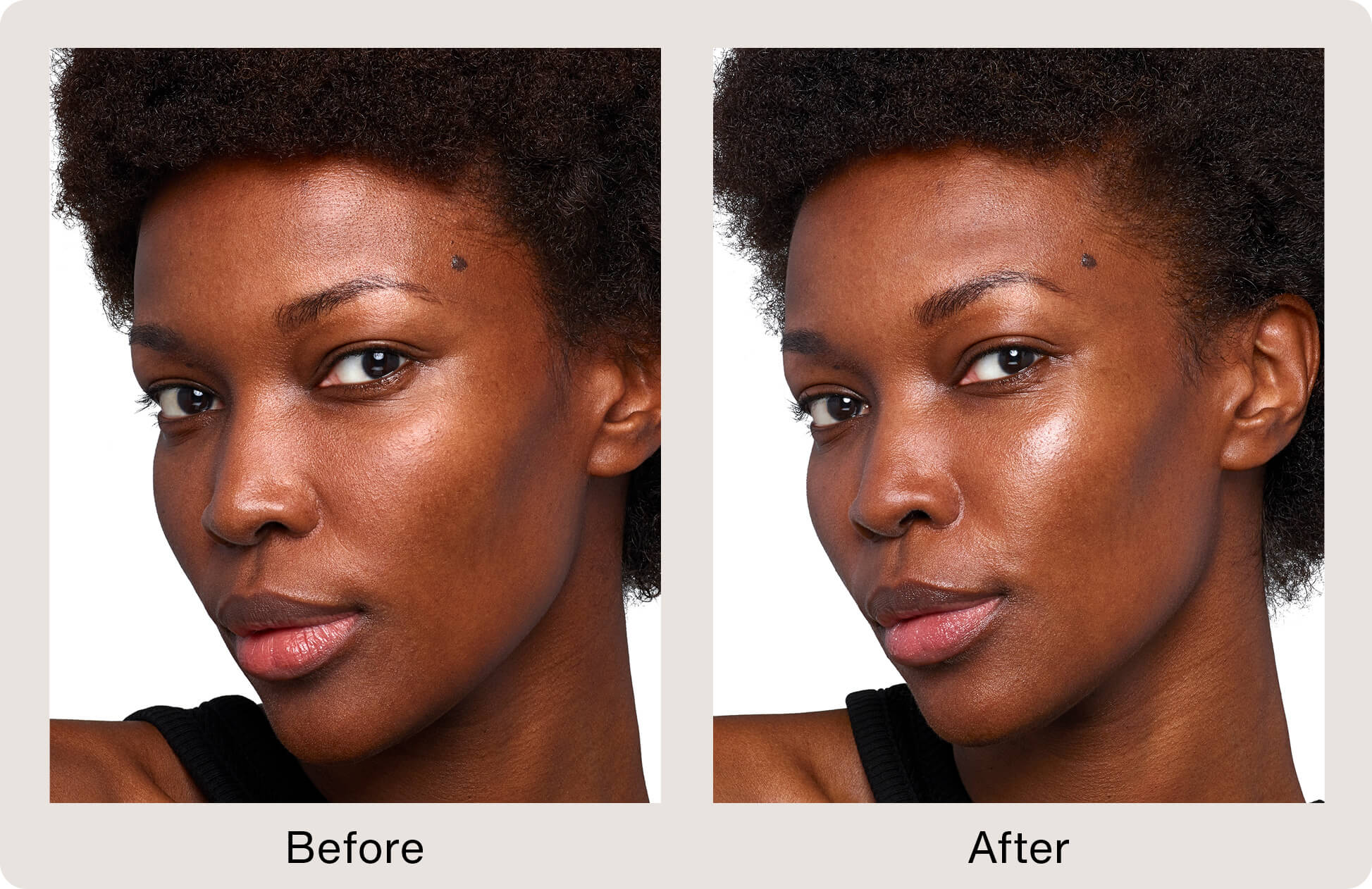 SKINVIVE by JUVÉDERM Before & After Images