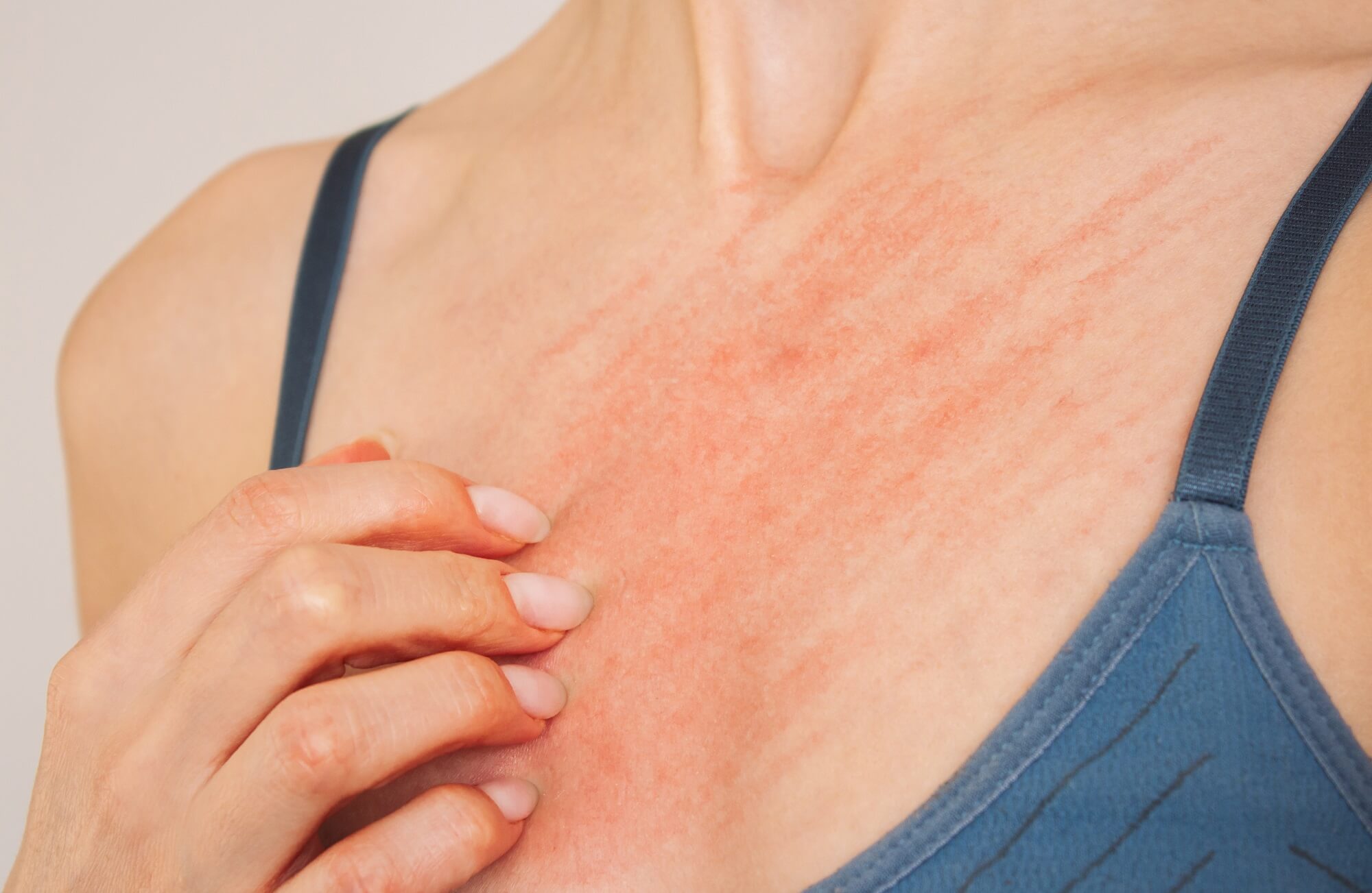Discover the stages, symptoms, and treatment options for shingles. Learn how to recognize early signs, get treatment, and prevent complications. Get informed!
