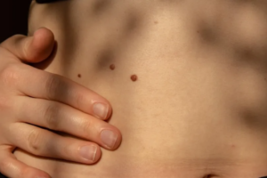 Well_Good - What It Means When a Mole Grows Hair, According to a Dermatologist - Paul Curtiss, MD, FAAD
