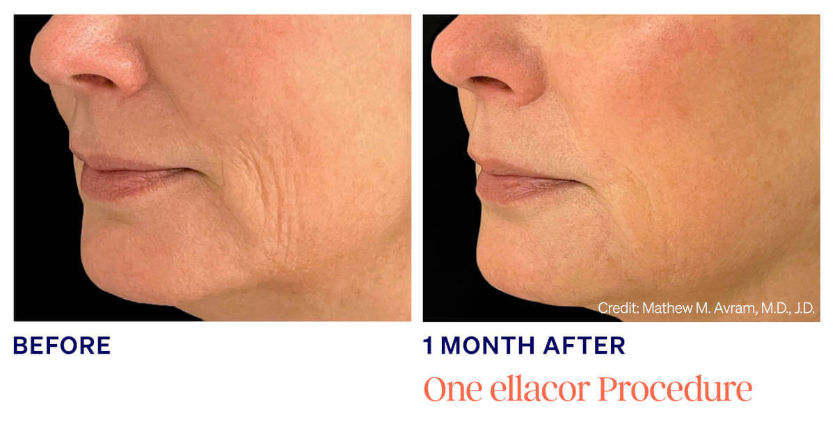 Ellacor treatments utilizes newly developed micro-coring technology to improve the appearance of moderate to severe wrinkles and excess skin.