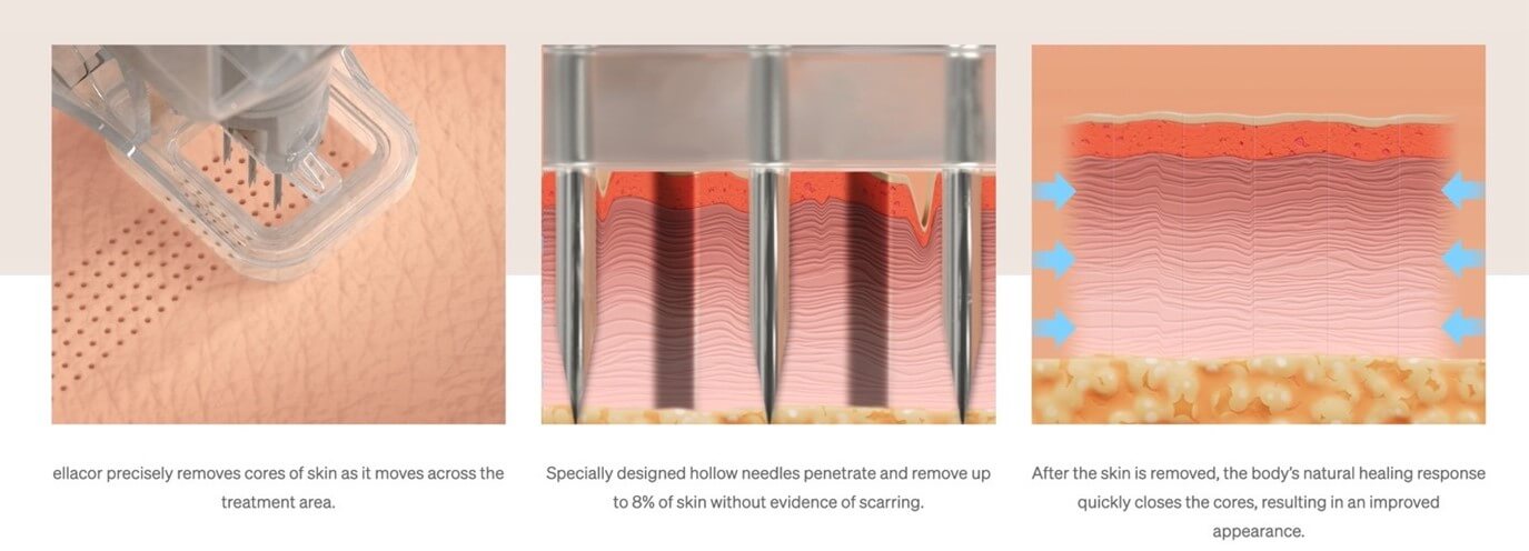 The Ellacor treatment procedure uses hollow needles, like the ones utilized to draw blood, to remove micro-cores of skin on the mid to lower part of the face. The comfortable, in-office procedure is completed in about 30 minutes on average.