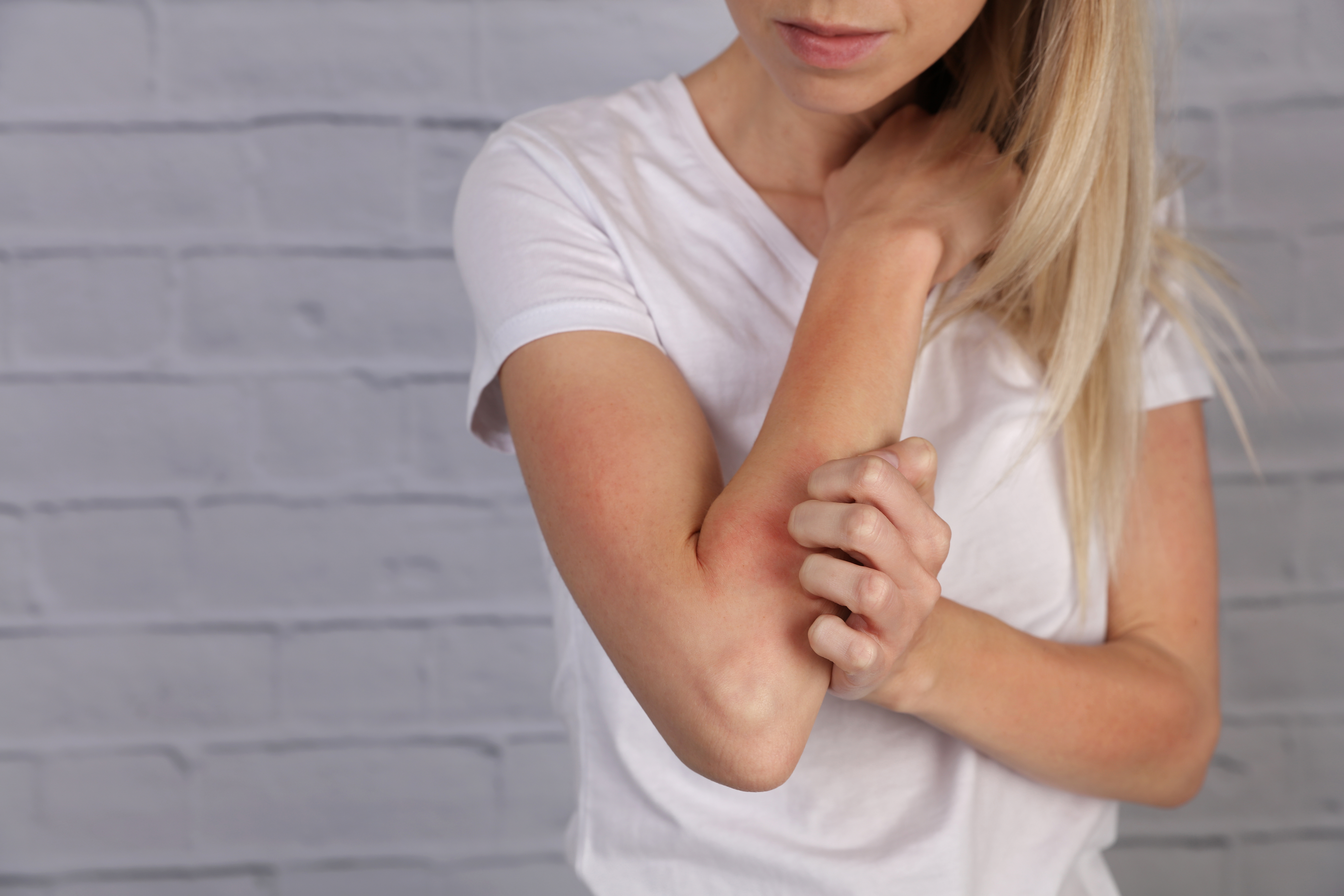 A women in a white shirt scratching her irritated, red elbow against a gray brick wall background.