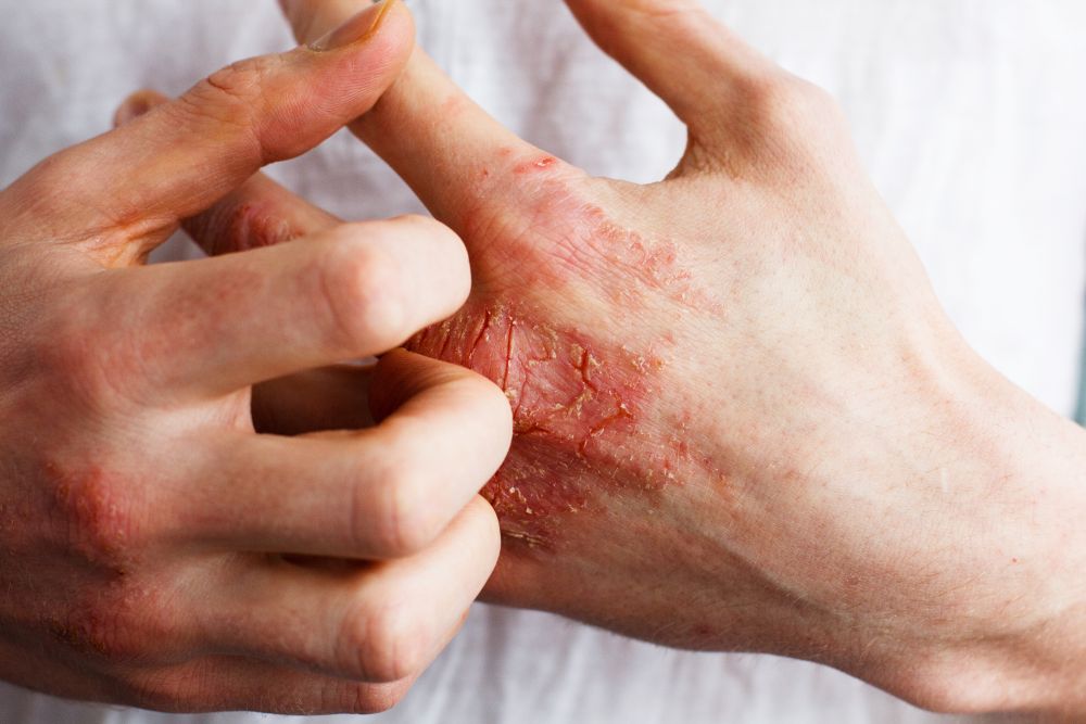 hand eczema treatment